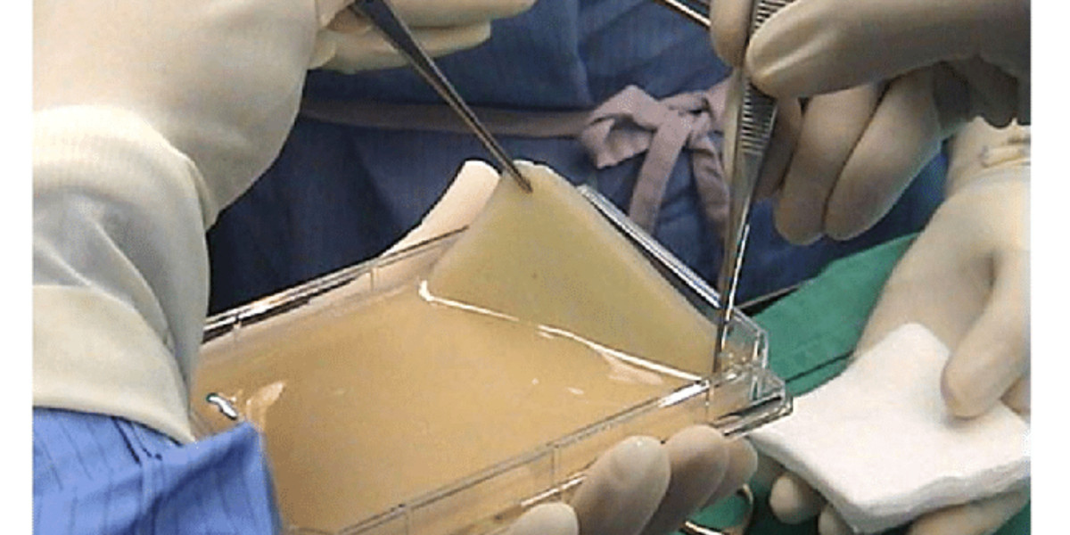 How Dual Layer Membranes Complement Amniotic Grafts in Wound Management