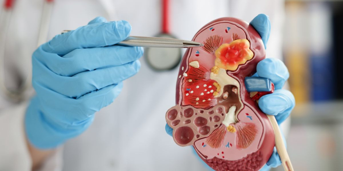 El Mercado de Tratamiento de la Lesión Renal Aguda: Crecimiento, Tendencias y Perspectivas (2024-2032)