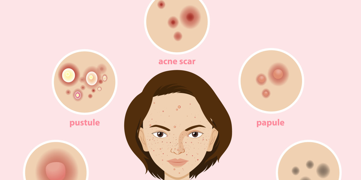 Understanding Acne: Causes, Triggers, and Effective Treatments