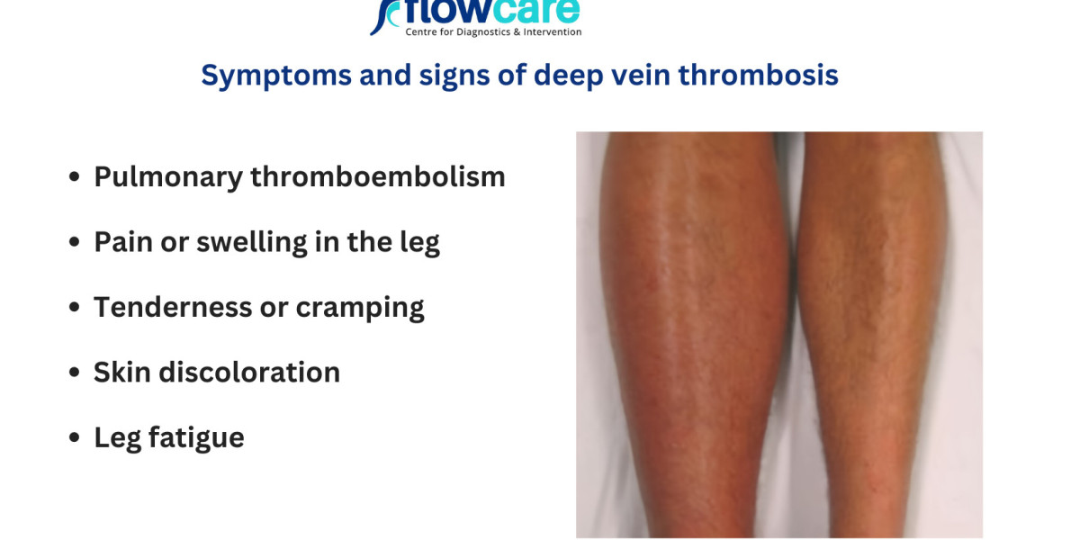 Understanding Deep Vein Thrombosis Symptoms: A Complete Guide