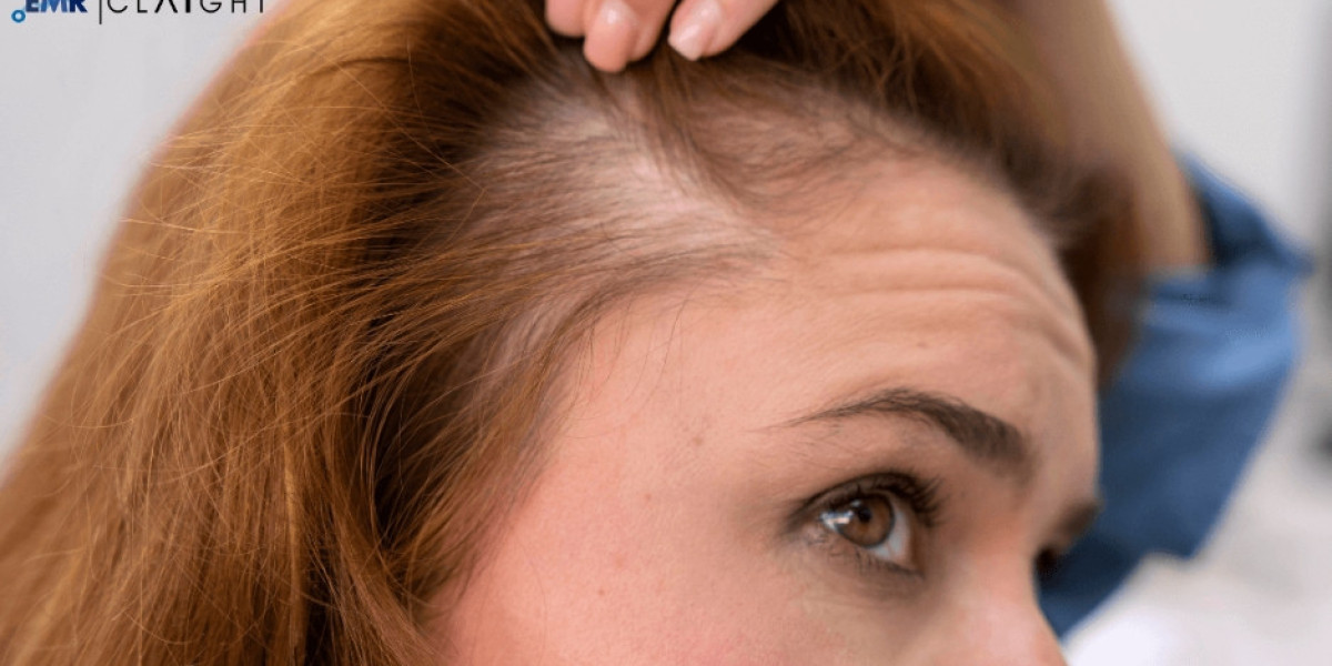 Global Alopecia Market Size