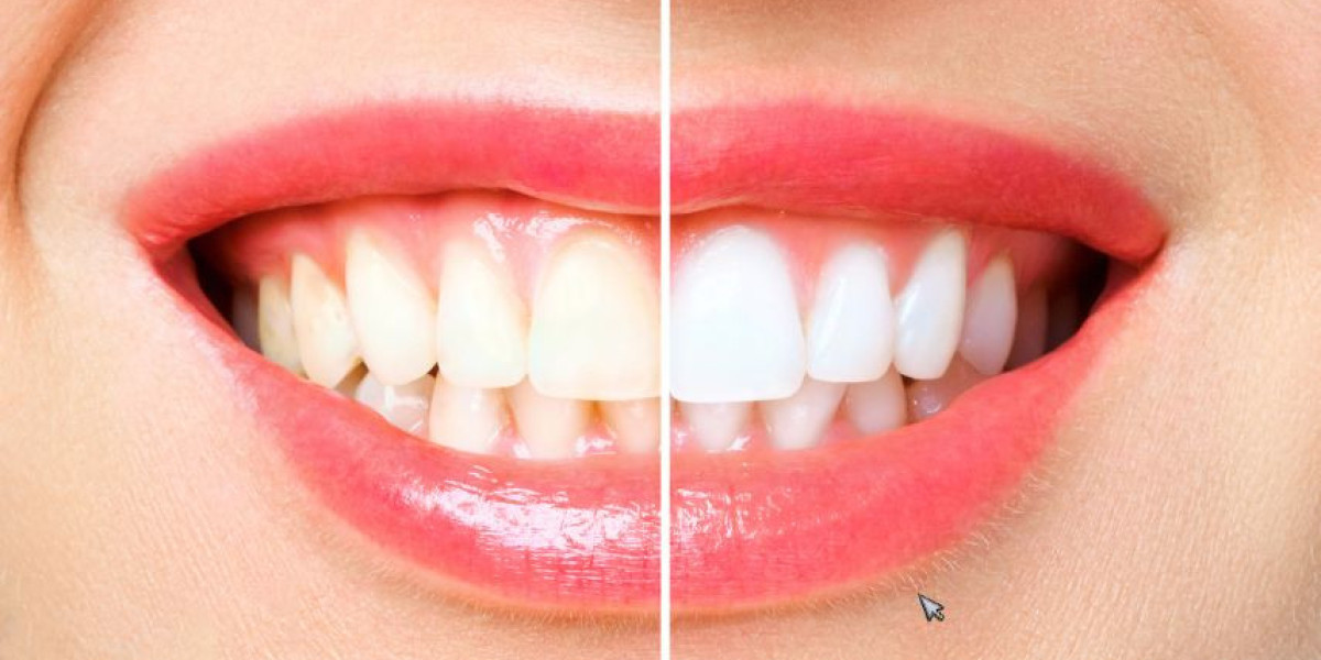 Top Benefits of Professional Teeth Whitening in London