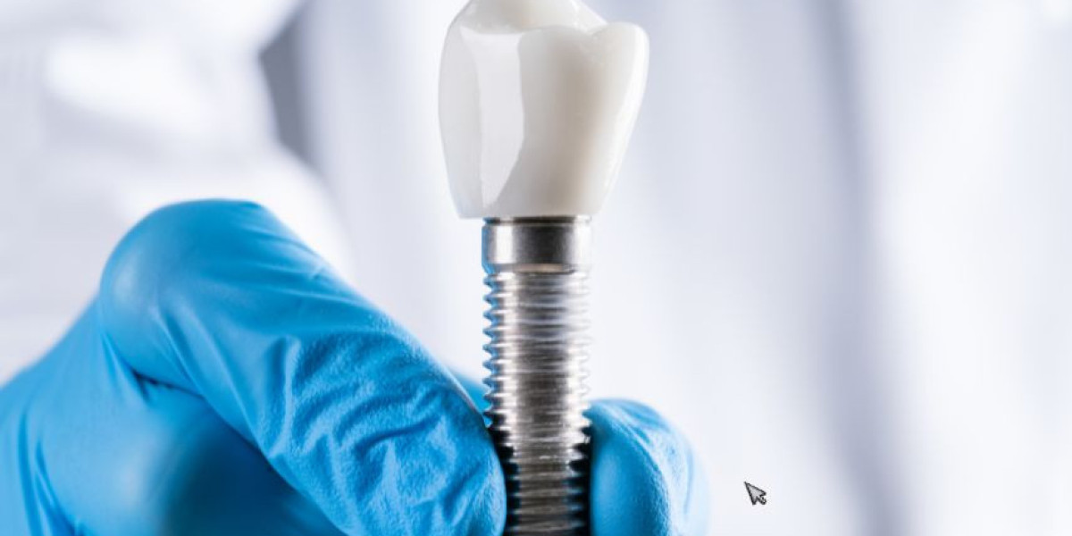 The Complete Guide to Dental Implants in London