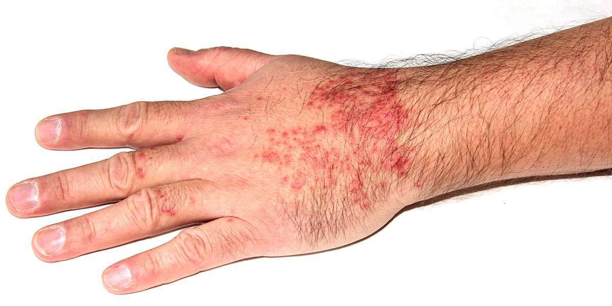 Redefining Eczema Care: OPZELURA’s Impact on Atopic Dermatitis