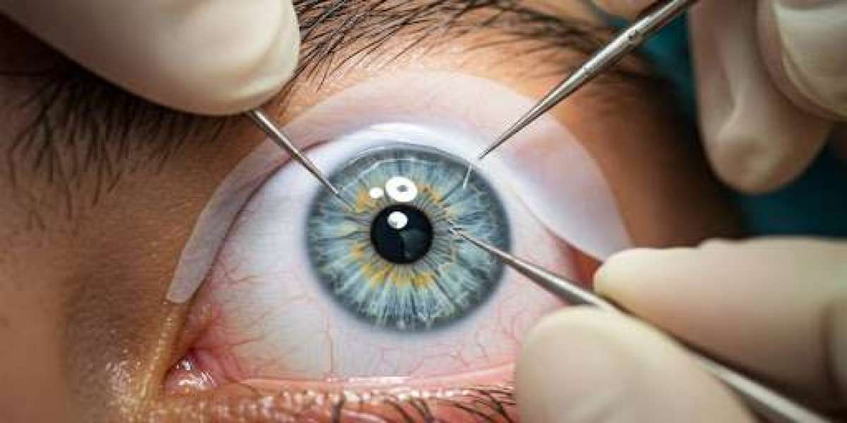 Can I Bend After LASIK?