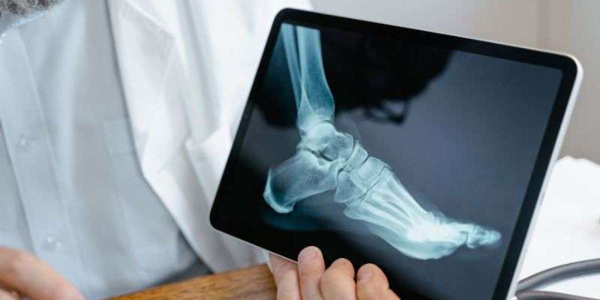 Ankle Fracture Treatment: A Comprehensive Overview