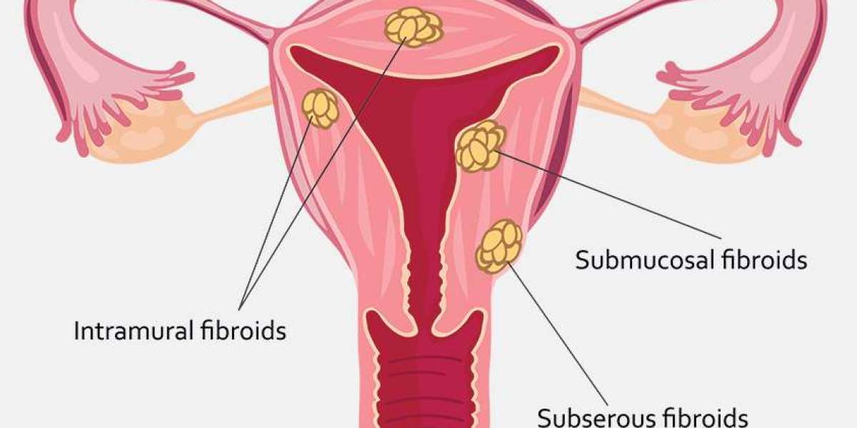 Laparoscopic Surgery for Myomectomy in Chennai: A Minimally Invasive Solution for Fibroids