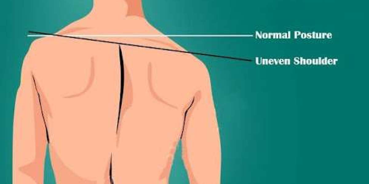 How to Fix Uneven Shoulders: Causes, Exercises, and Solutions for Balance