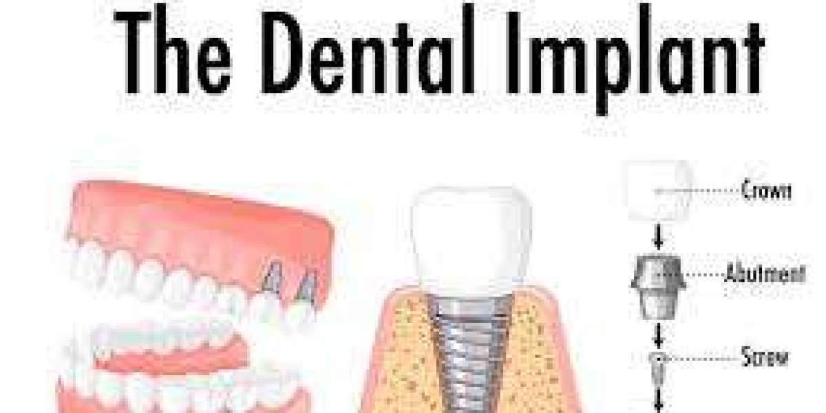 Dental Implants Cost in Pakistan: Everything You Need to Know