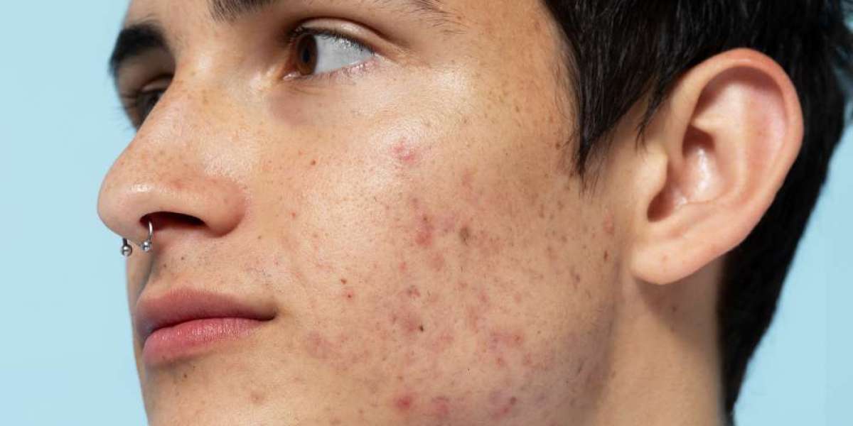 Homeopathy vs Allopathy for Skin Treatment: Which Wins?