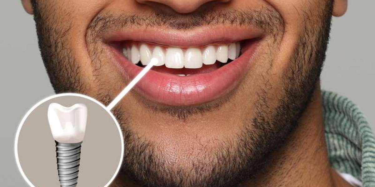 Dental Implants Cost in Pakistan: Everything You Need to Know