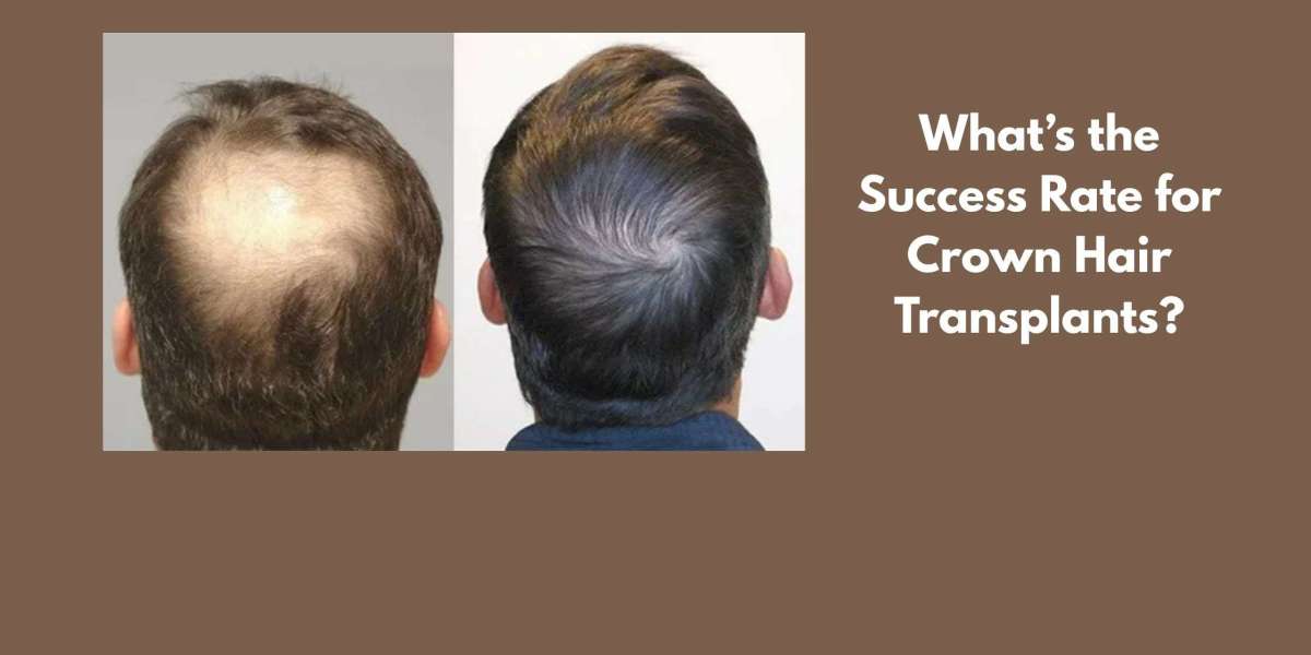 What’s the Success Rate for Crown Hair Transplants?