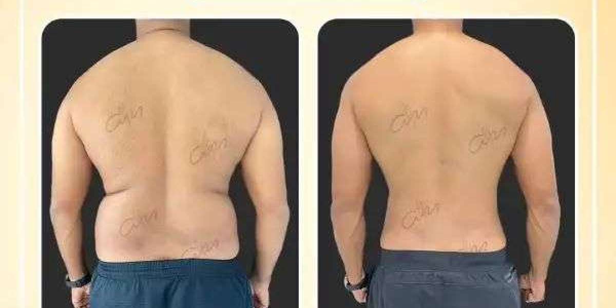 Achieve a Sculpted Look with Liposuction in Dubai by Dr. Hans
