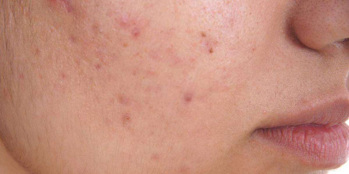 What Is Acne? Causes, Types, and Treatment Explained