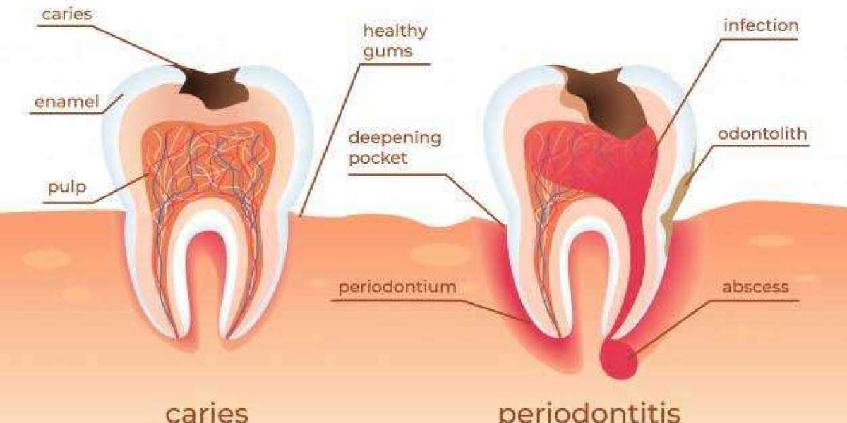 Gum Disease Treatment at a Trusted Dental Clinic in Bakersfield